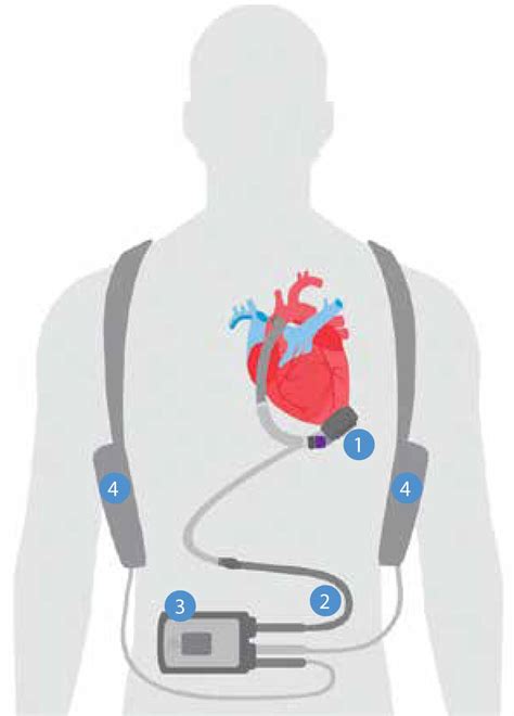 Vad Ventricular Assist Device Norton Healthcare Louisville Ky