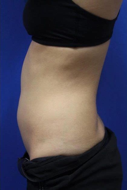 Patient 14241 Body Contouring Before And After Photos New York Ny Plastic Surgery Gallery Dr