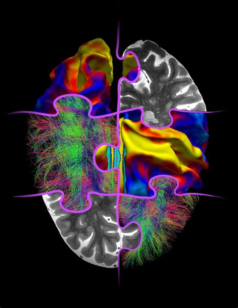 Bringing Puzzle Pieces From Multimodal MRI Together To See The Big