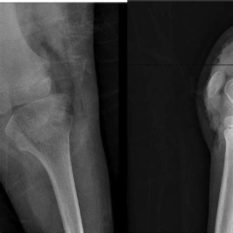 Anteroposterior And Lateral Radiographs Of The Left Knee Reduction Of