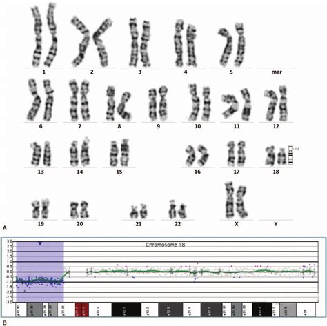 Prenatal Diagnosis Of 18p Deletion Syndrome In Case 2 A The Results Download Scientific