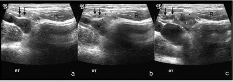 Inguinal Hernia Female Ultrasound