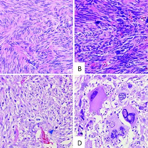 Microscopic Findings Of The Tumor A Section 10 In Fig 1c