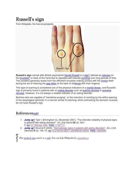 Russells Sign References Pdf Bulimia Nervosa Eating Disorder