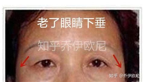 为什么割的双眼皮会显得假