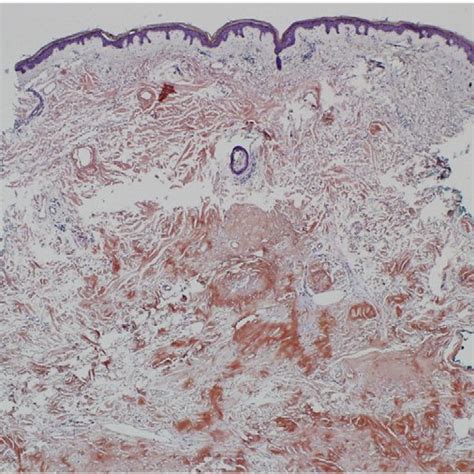 Summary Of Case Features Of Localized Cutaneous Nodular Amyloidosis In