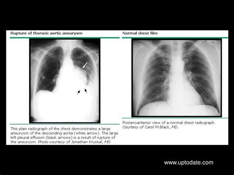 Ppt Diseases Of The Aorta Powerpoint Presentation Free Download Id 6580694