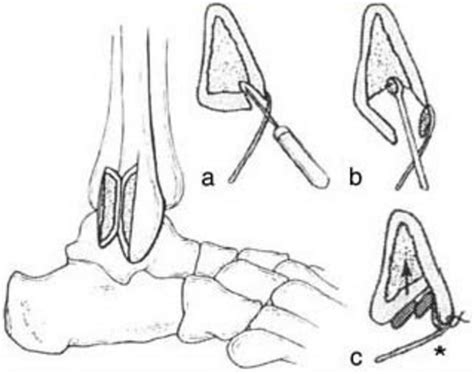 Peroneal Tendon Tears and Instability - Foot & Ankle - Orthobullets