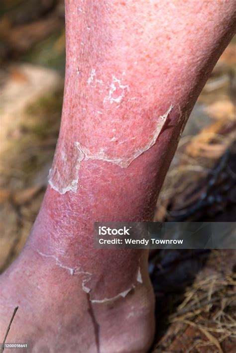 Cellulitis On Leg And Foot Of Mature Diabetic Man In Daylight Outdoors