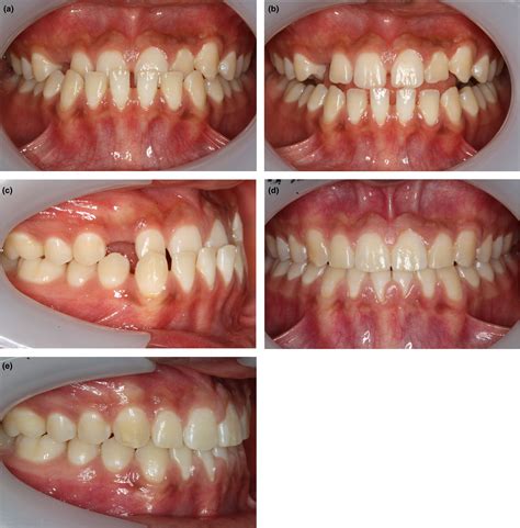 Timing Orthodontic Treatment Early Or Late Fleming