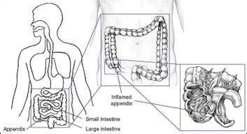 Laparoscopic Appendectomy Anatomy