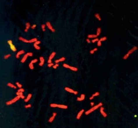 A Metaphase Preparation Of Halneo Cells Showing 6q And 6q T