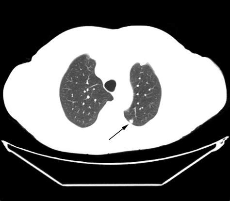 Met Stasis Pulmonar La Imagen Muestra Una Met Stasis Milim Trica