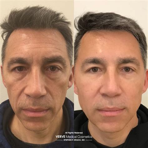 Mastering Masculinity Enhancing Male Facial Features With Dermal