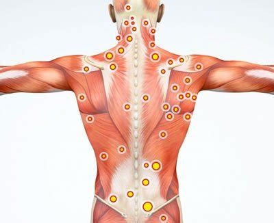 Myofascial Pain Syndrome Treatment NYC | Back Pain Doctors