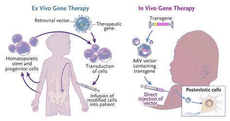 邦耀 Nejm最新综述 简述基因治疗的最新临床研究进展