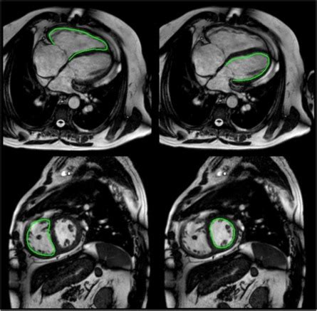 Quantification Of Biventricular Myocardial Function Using Cardiac