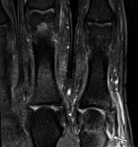 High Resolution 3 T MRI Of The Fingers Review Of Anatomy And Common