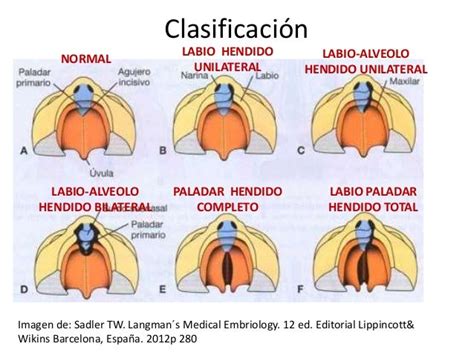 Labio Paladar Hendido