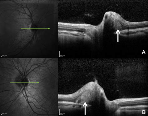 Differentiating Mild Papilledema And Buried Optic Nerve Head Drusen