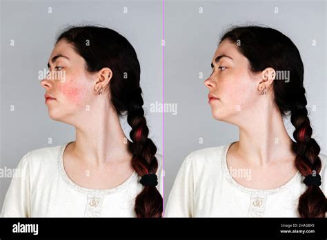 Portrait Of A Young Caucasian Woman With Red And Inflamed Blood Vessels