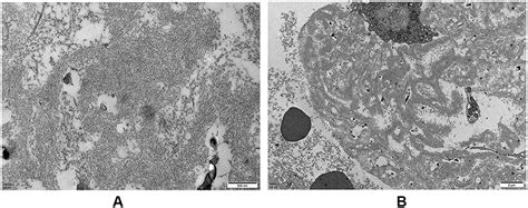 Multiple Myeloma Associated Systemic Amyloidosis Ccid