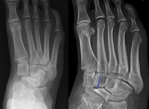 Imaging Features Of Avascular Necrosis Of The Foot And Ankle Foot And