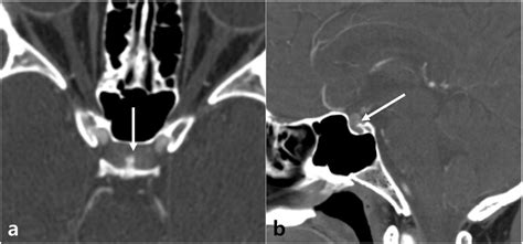 A And B Axial And Sagittal Contrast Enhanced Computed Tomography