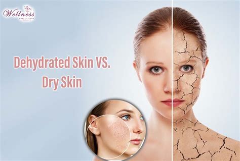 Dehydrated Skin How Does It Look And What Are The Treatments