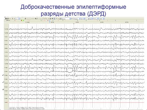 Основы клинической электроэнцефалографии. Патологическая ЭЭГ при ...