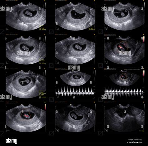 Ecografia Uterina Normale Immagini E Fotografie Stock Ad Alta