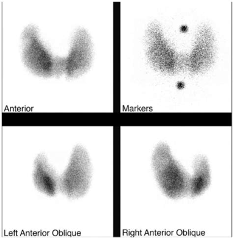 Thyroid Uptake And Scanthyroid Scan Reflecting Uptake Open I