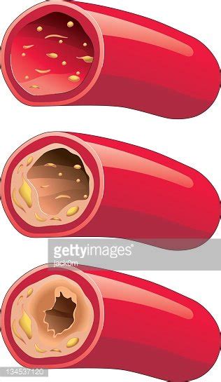 Illustrates The Progression Of Atherosclerosis In Cvd Patients Stock