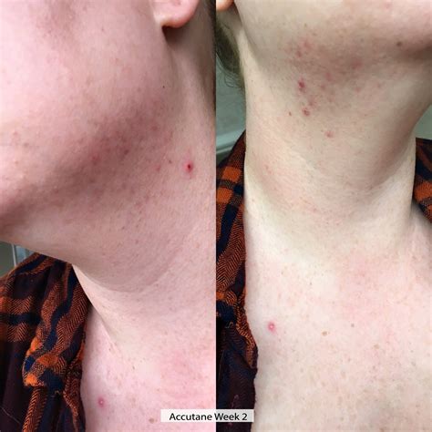 Accutane Before During And After