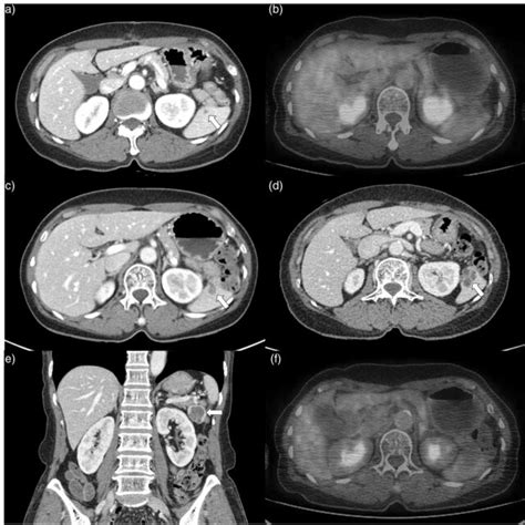 Splenic Mesothelial Cyst In A 66 Year Old Woman With Ascending Colon