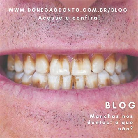 Manchas Nos Dentes O Que S O Doneg Odontologia Dentista Em