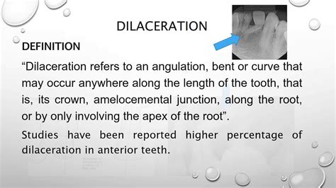 Dilaceration Teeth