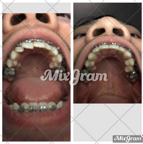 2 Month Braces Progress Braces