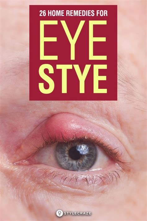 How To Get Rid Of A Stye 26 Home Remedies And Precautions Eye Stye Remedies Stye Treatment