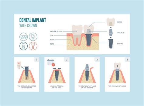 Dental Implant Procedure What To Expect And How To Prepare Picasso