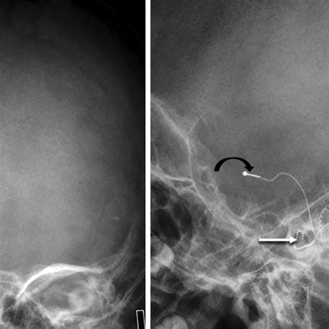 4a And B Postoperative Radiographs Anteroposterior A And Lateral B