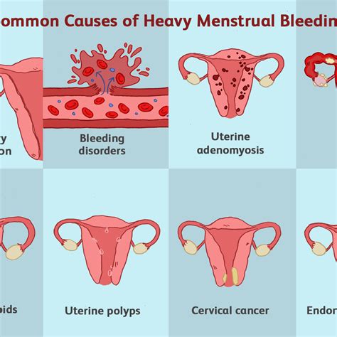 Positive Pregnancy Test But Bleeding And Clots Slenderidea