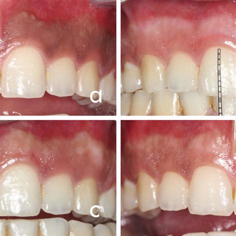 Removal Of Gingival Melanin Hyperpigmentation Using Diode Laser A