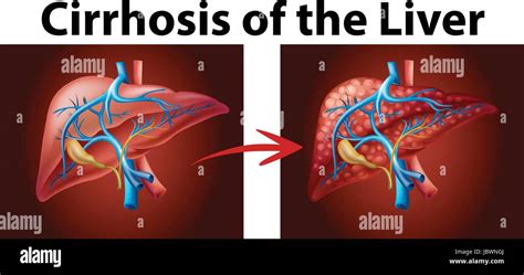 Ejemplo De La Cirrosis Del Higado Stock De Ilustraci N Ilustraci N De