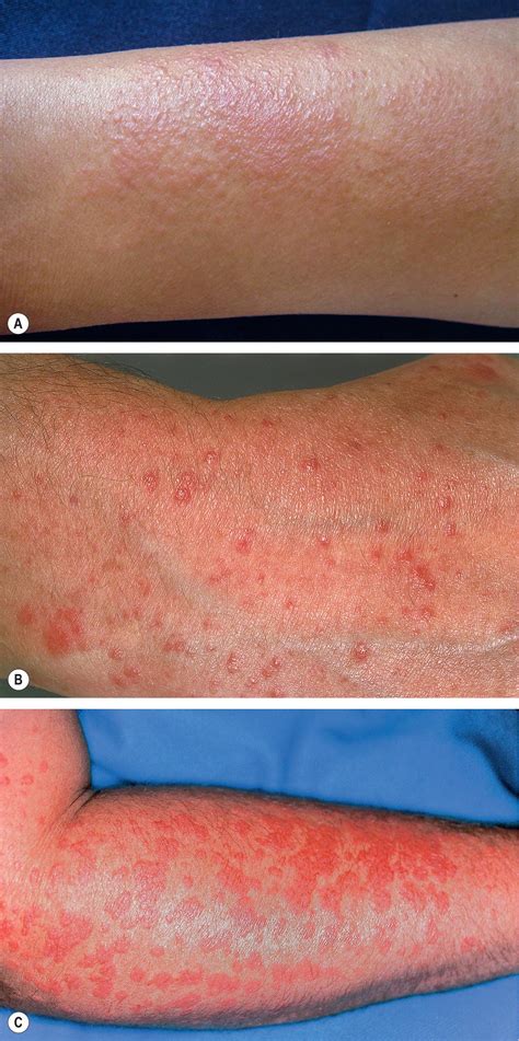 Photodermatologic Disorders Clinical Tree