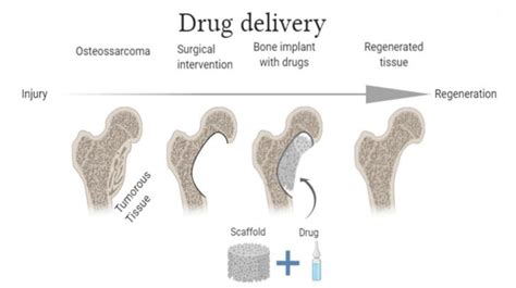 Figure 1 From Calcium Phosphate Based Bioceramics In The Treatment Of