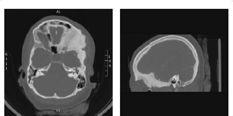 A and B: CT scans of case no. 1 showing sphenoid wing skull base ...