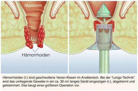 Hämorrhoiden Was tun wenn Probleme unerträglich werden