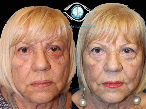 Blepharoplasty Complications Prof Francesco Bernardini