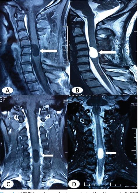 Figure 1 From Anterior Cervical Corpectomy And Fusion With Excision Of